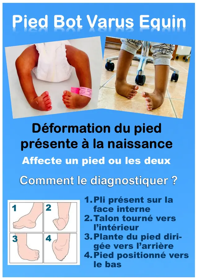 Qu’est-ce que le Pied Bot Varus Équin ?