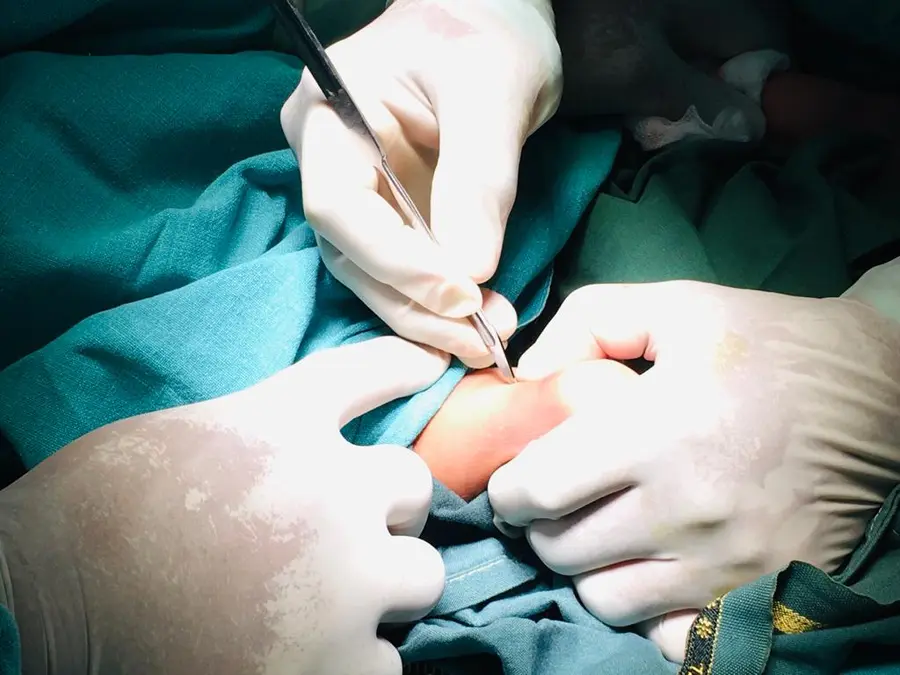 Seconde étape de la Méthode Ponseti: Ténotomie de tendon d'Achille